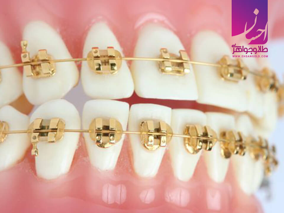 استفاده از طلا در دندانپزشکی |طلا|طلا و جواهر احسان|فروش اقساطی طلا